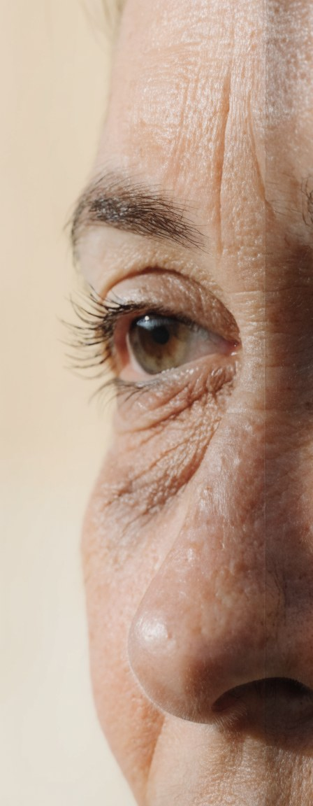 BEFORE eye area close-up